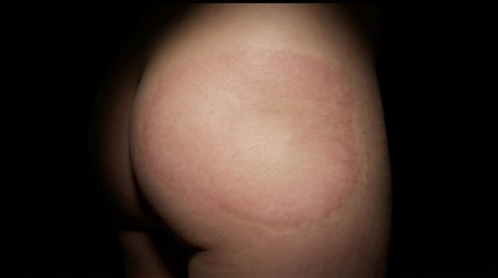 Same skin from the opening shot, healed and grafted, no burn remaining