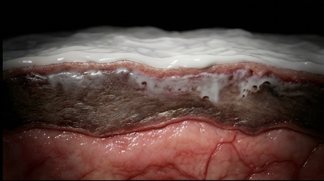 Silver sulfadiazine penetrating only the surface layer of the eschar