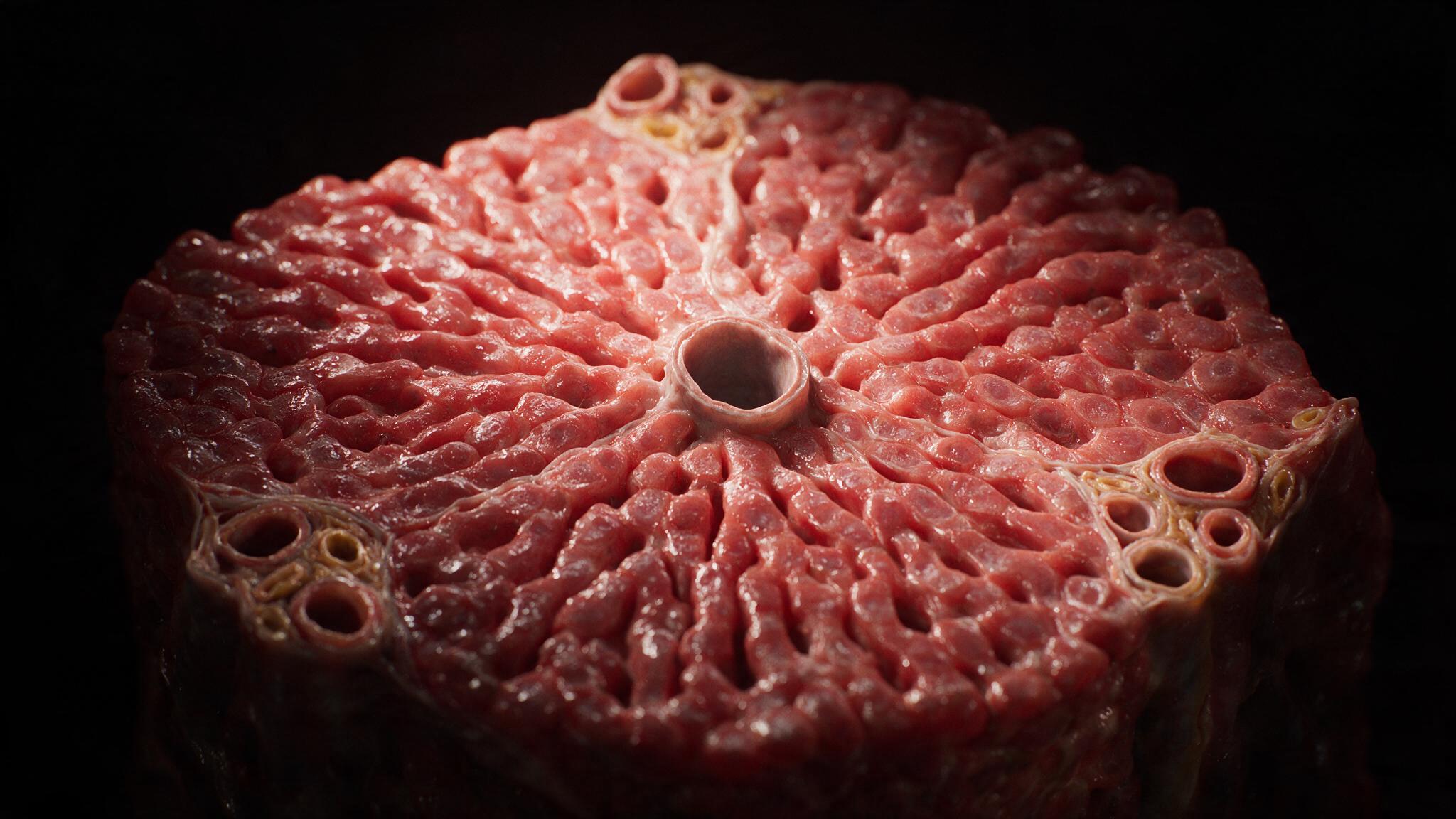 Nutmeg Liver — chronic passive congestion, centrilobular necrosis, congestive hepatopathy