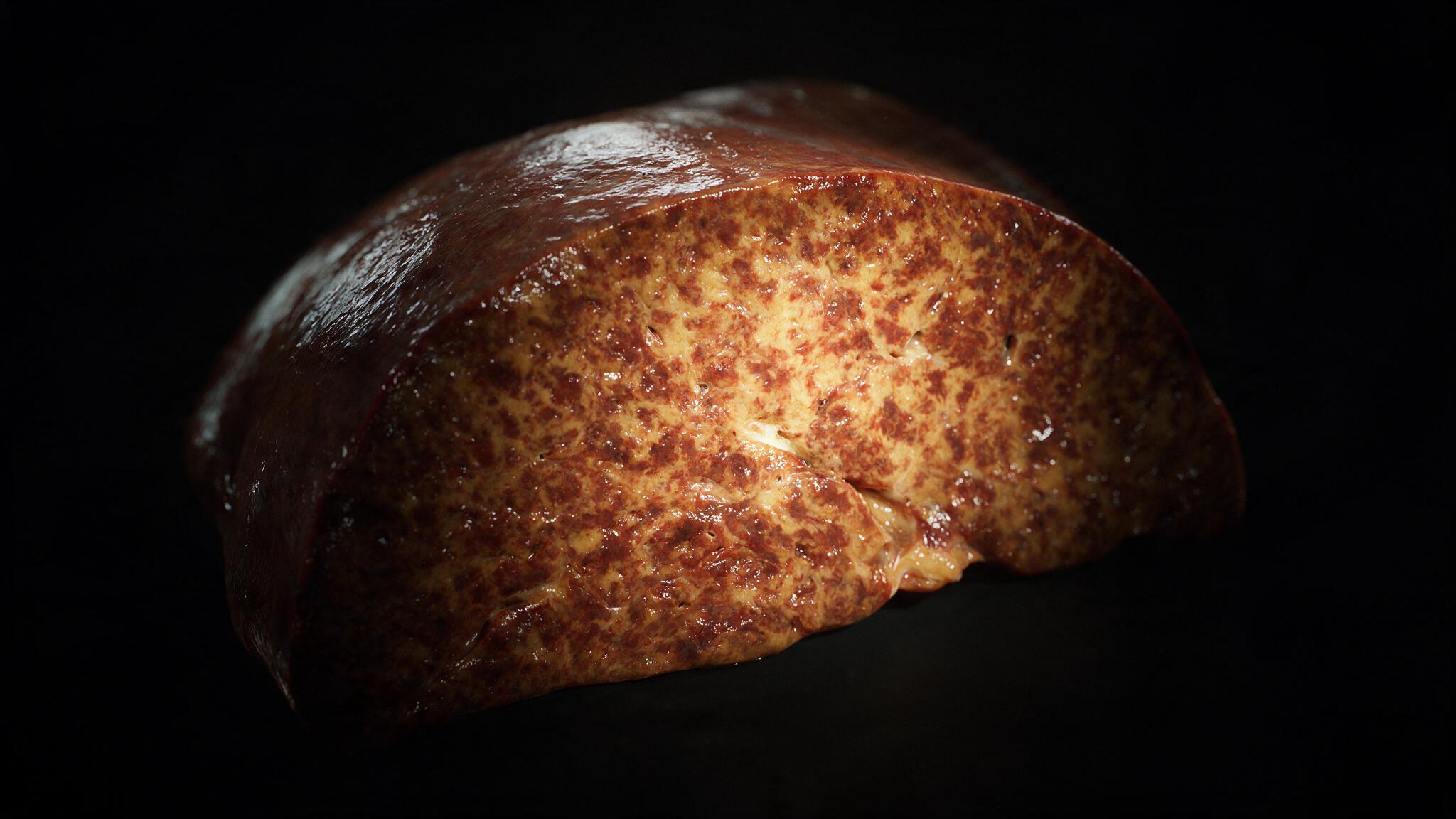Gross nutmeg liver specimen: mottled cut surface with dark congested centrilobular zones alternating with pale periportal tissue
