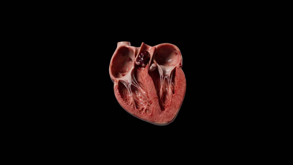 Pulmonary embolism: dissected heart showing clot in right-side chambers, before dilation