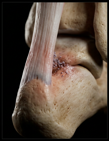 Cross-reactive T-cells attacking the Achilles enthesis at its exact anatomical insertion point on the calcaneal tuberosity