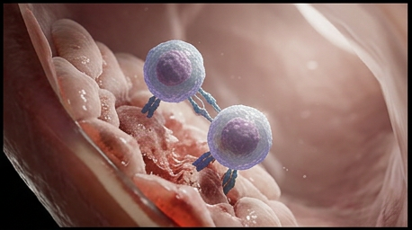 T-cell directly attacking joint tissue, fluid remaining completely organism-free
