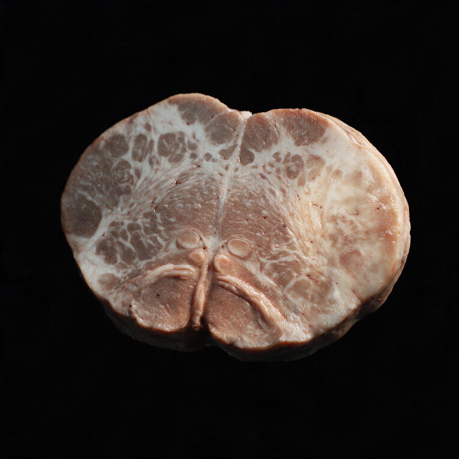 Wallenberg Syndrome — lateral medullary infarct, brainstem stroke, cranial nerve nuclear localization