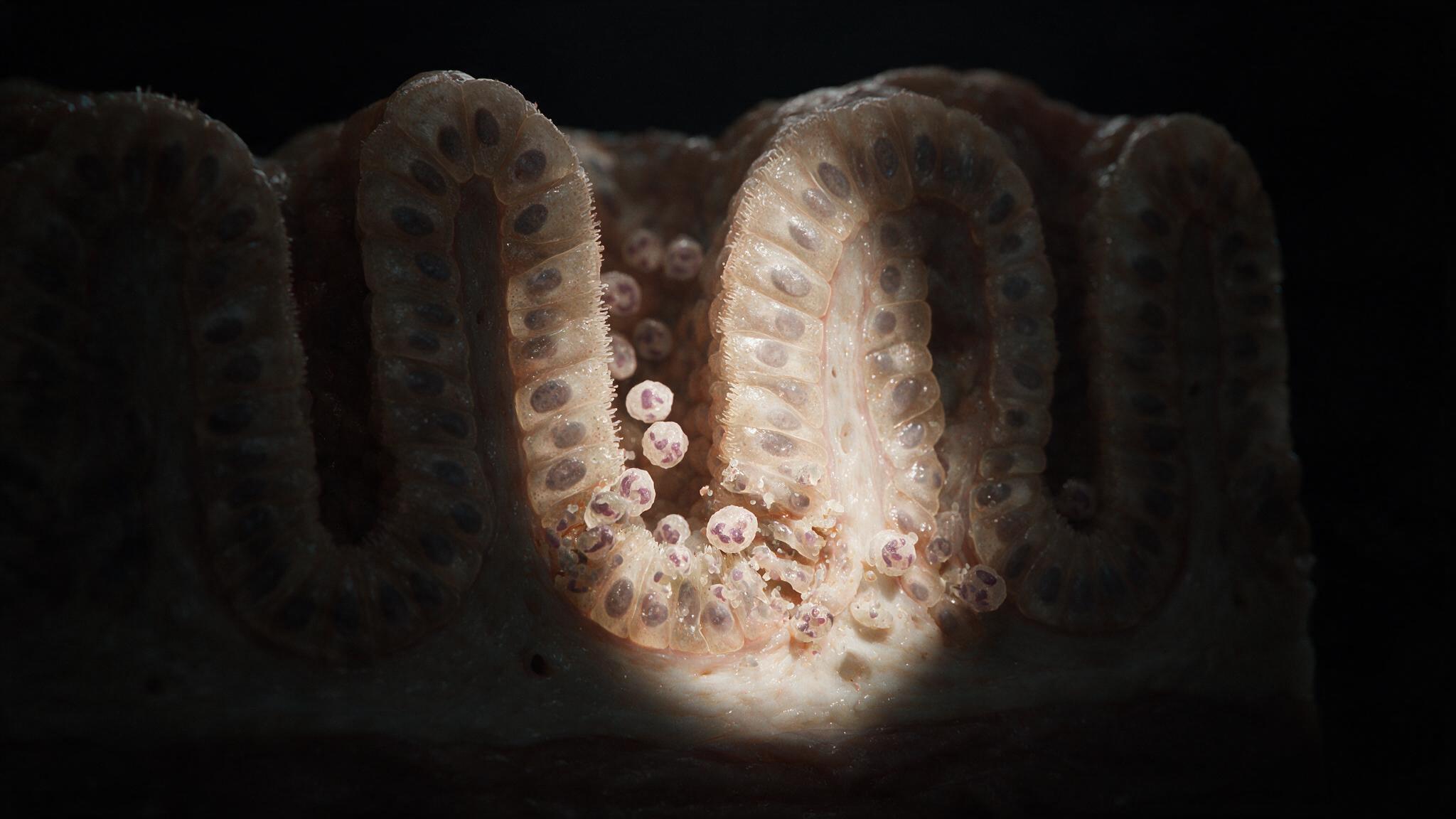 Crohn's Disease — crypt abscess, neutrophil attack within intestinal crypt, transmural inflammation, UE5 cinematic macro