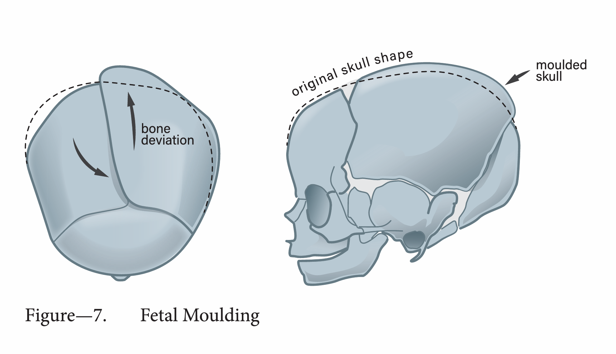 Fetal moulding of the skull