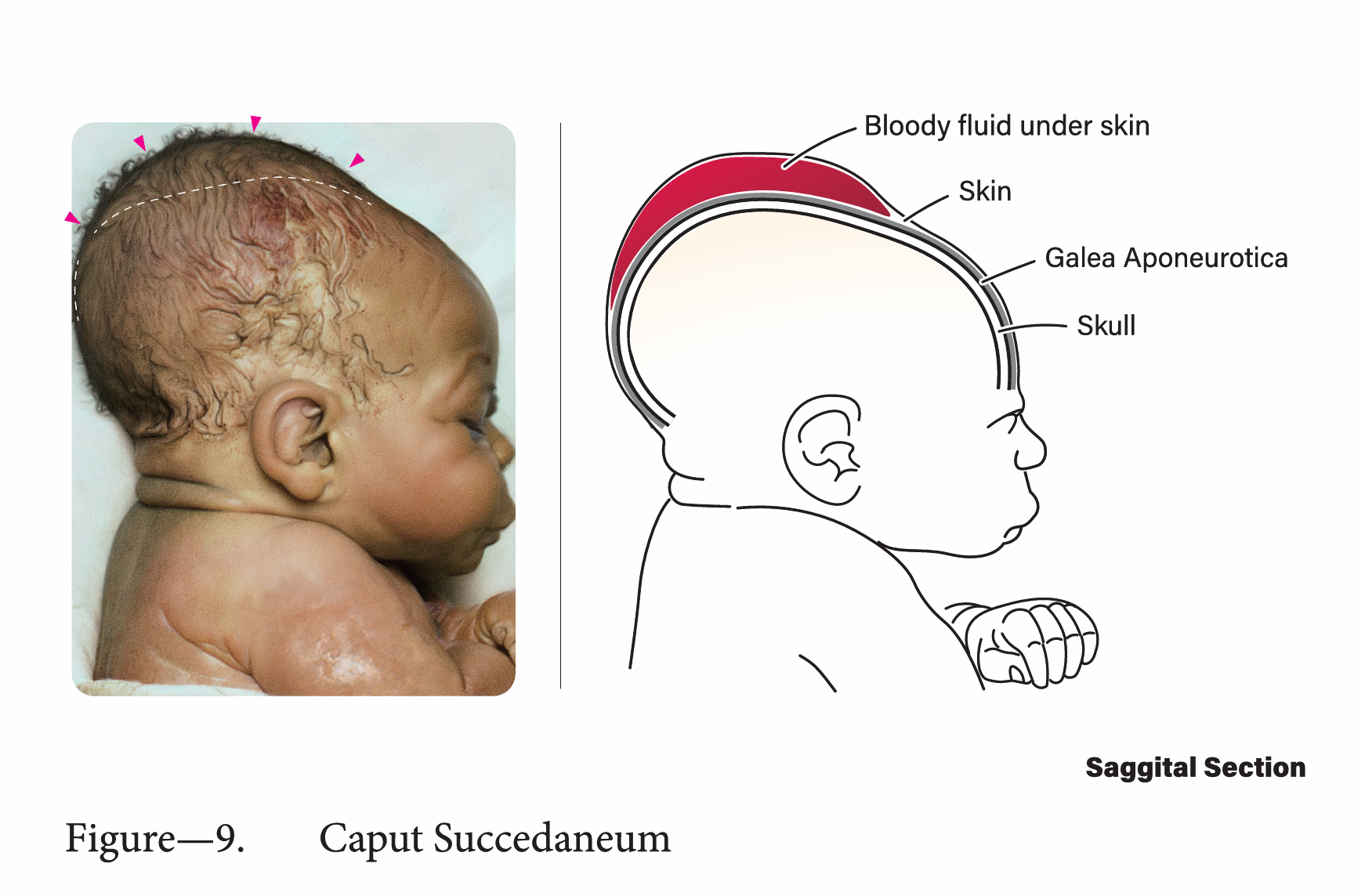 Caput succedaneum and neonatal scalp injury