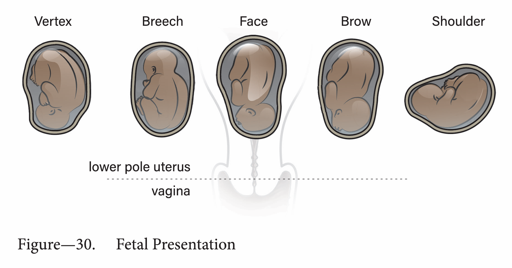 Fetal presentation: breech, face, shoulder, vertex