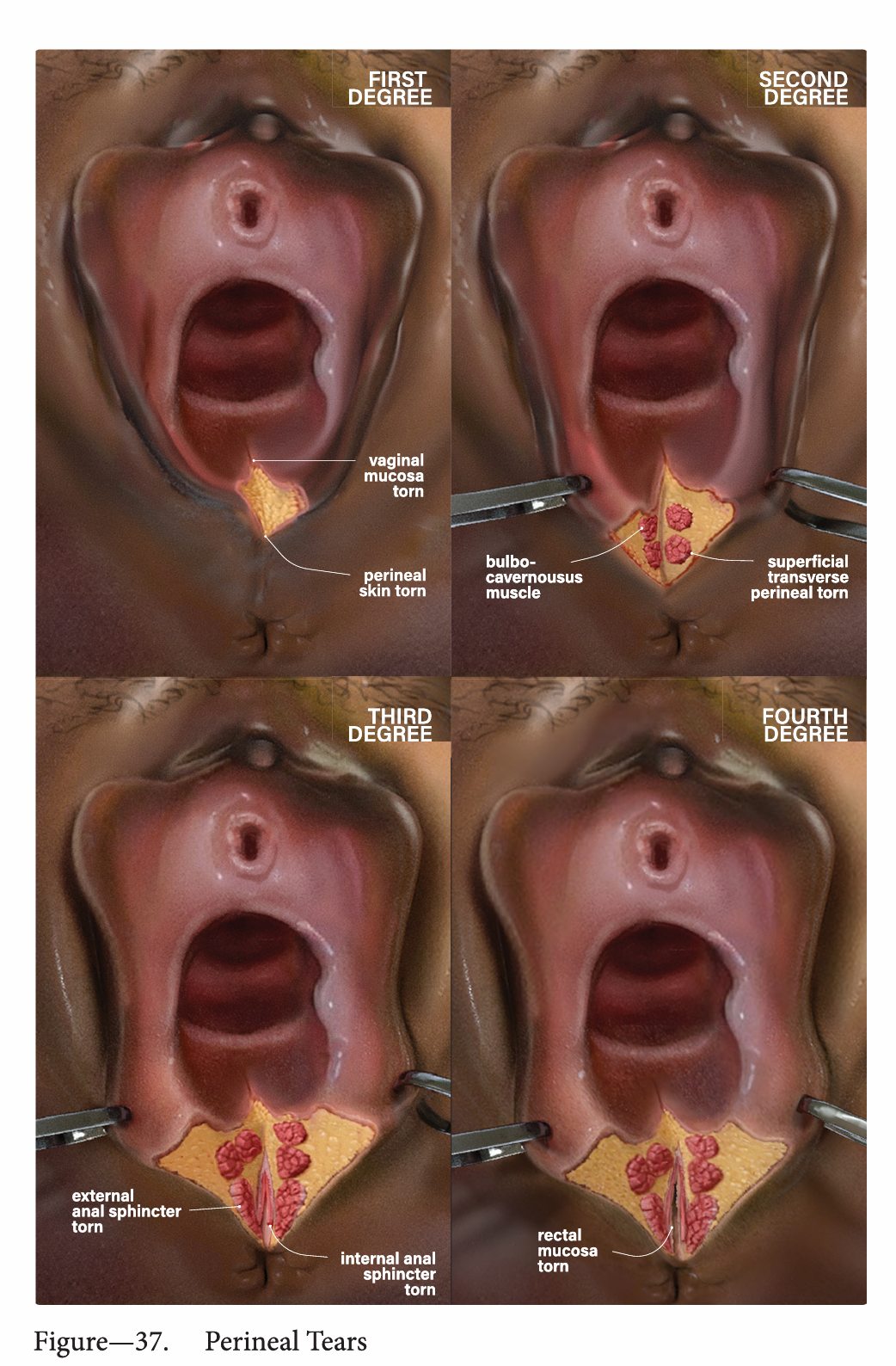 1st and 2nd degree perineal injury