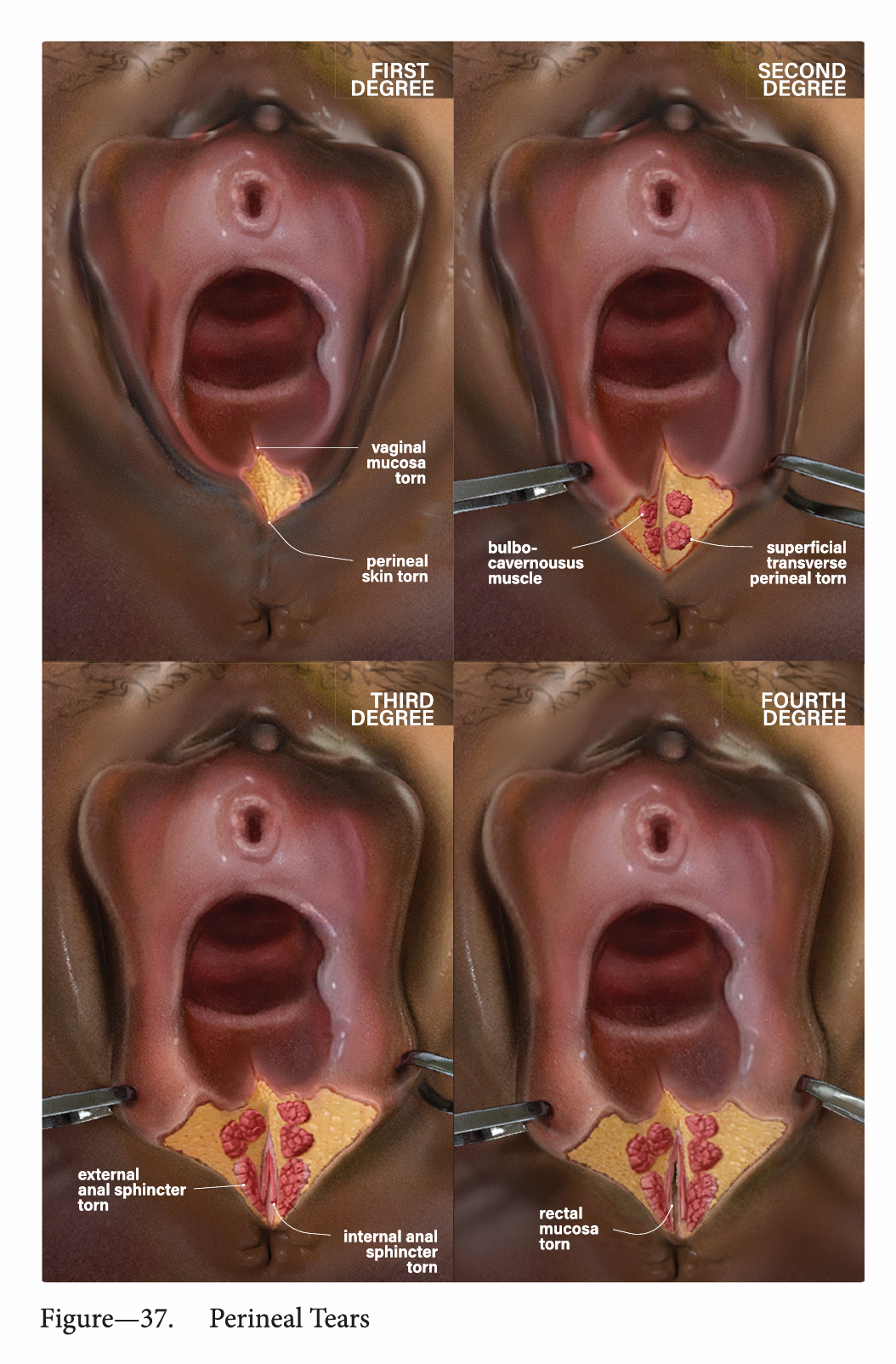 Surgical procedure plates